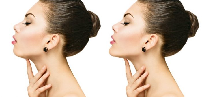 Jawline dolgusu ile yüz şekillendirme